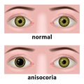 anisocoria. abnormally dilated pupil of the eye. Royalty Free Stock Photo